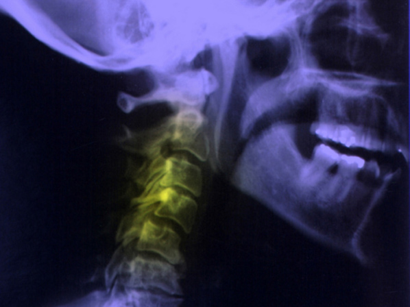 11 cambios que te protegen de un ataque cerebral - 6. Considera la cirugía de cuello